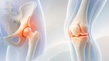 Knie- und Hüftarthrose: Was hilft wirklich?